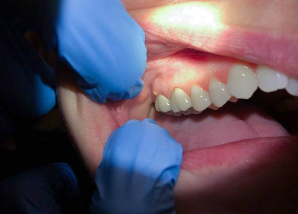 Best Emergency Gum Treatment in Pajaro, CA